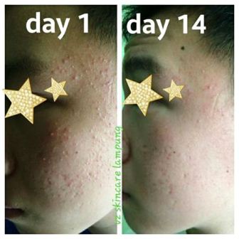 Efek Positif Menggunakan Produk Acne VZ Skincare